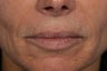 Radiesse to Lower Face