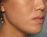 Radiesse in the chin