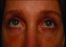 Radiesse under the eyes