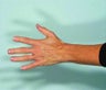 Radiesse hand rejuvenation