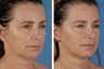 Radiesse & Botox Cosmetic