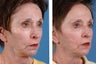 Radiesse & Juvederm