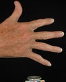 Hand Rejuvenation