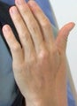 Radiesse Hand Rejuvenation