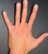 Hand rejuvenation