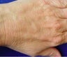 Radiesse hand rejuvenation