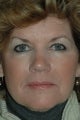 Botox and Fillers