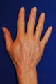 Radiesse Hand Rejuvenation