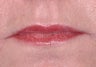 Radiesse and Restylane for Marionette Lines and Lips