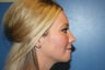 Radiesse for chin augmentation