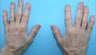 Hand Rejuventation