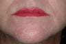 Radiesse and Botox