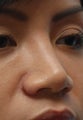 Non-Surgical Rhinoplasty