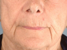 Radiesse/Juvederm