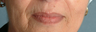Radiesse/Juvederm