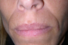 Radiesse/Juvederm