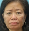 Upper Lid Blepharoplasty & NS Cheek Enhancement (Radiesse)