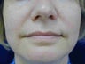 Radiesse treatment