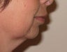 Injectables