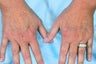 Radiesse for Hand Rejuvenation