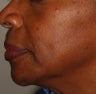 Radiesse Treatment