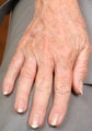 Radiesse treatment for hand rejuvenation