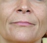 Radiesse treatment for nasolabial folds