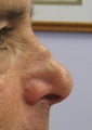 Filler Nose Job