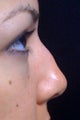 Lunch Time Nose Job using Radiesse