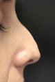 Nasal Tip created using Radiesse