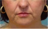 Radiesse injection nasolabial folds and marionette lines