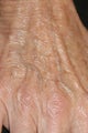 Radiesse hand injection
