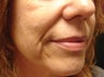 Radiesse Injection into the Cheeks and Nasolabial Folds
