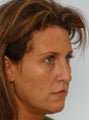 Radiesse