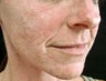Mid Face and Lip Correction