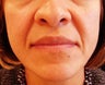 Nasolabial Fold Treatment