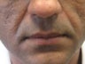 Radiesse Injections