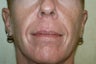 Radiesse and Juvederm XC