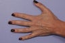 Radiesse to Hands