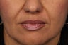 Radiesse to Smile Lines (nasolabial folds)