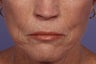 Radiesse and Juvederm - Smile lines