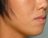 Radiesse in the chin