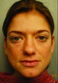 Radiesse injections