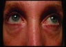 Radiesse under the eyes