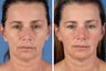 Radiesse & Botox Cosmetic
