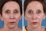 Radiesse & Juvederm
