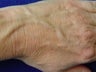 Radiesse hand rejuvenation
