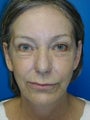 Filler, Botox, and Laser Resurfacing
