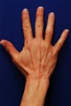 Radiesse Hand Rejuvenation