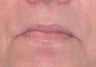 Radiesse and Restylane for Marionette Lines and Lips